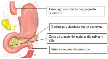 bypass